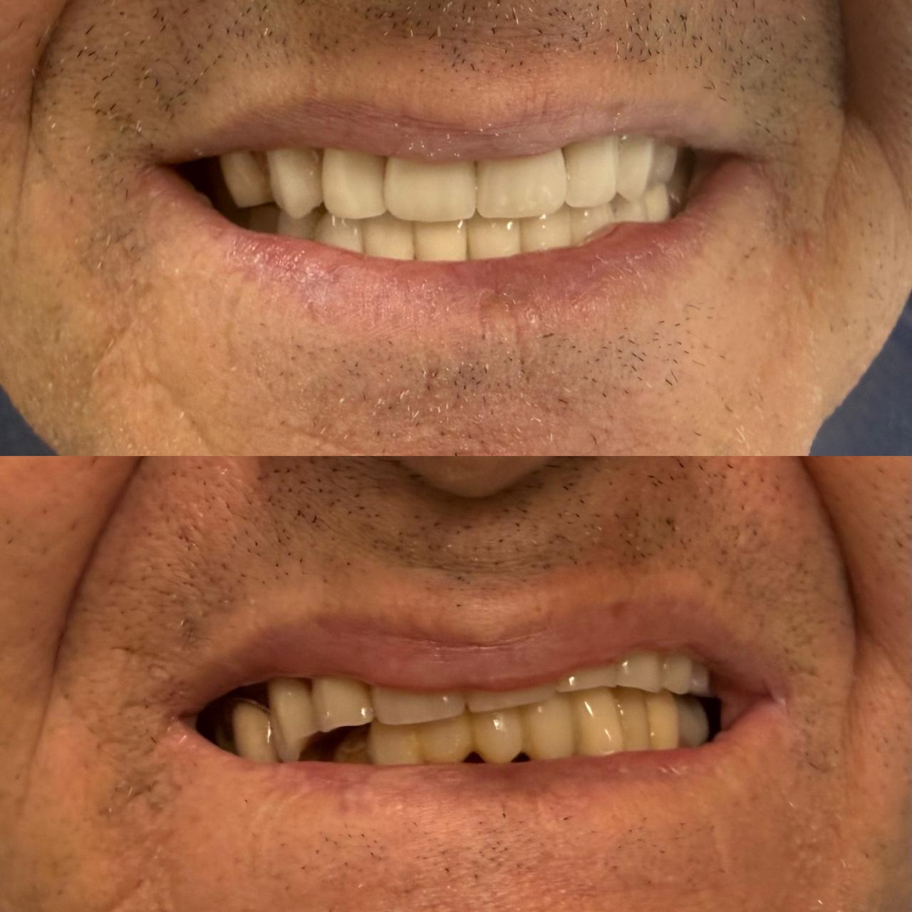 Smile design para dhe pas