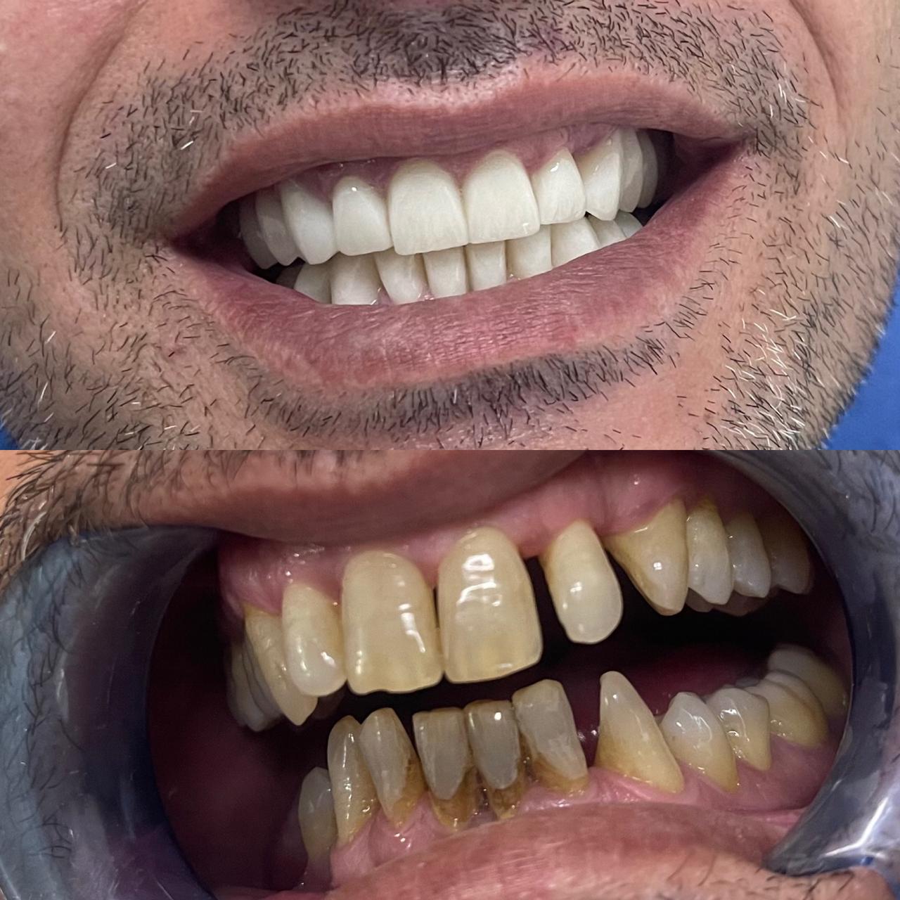 Kurora zirconia para dhe pas