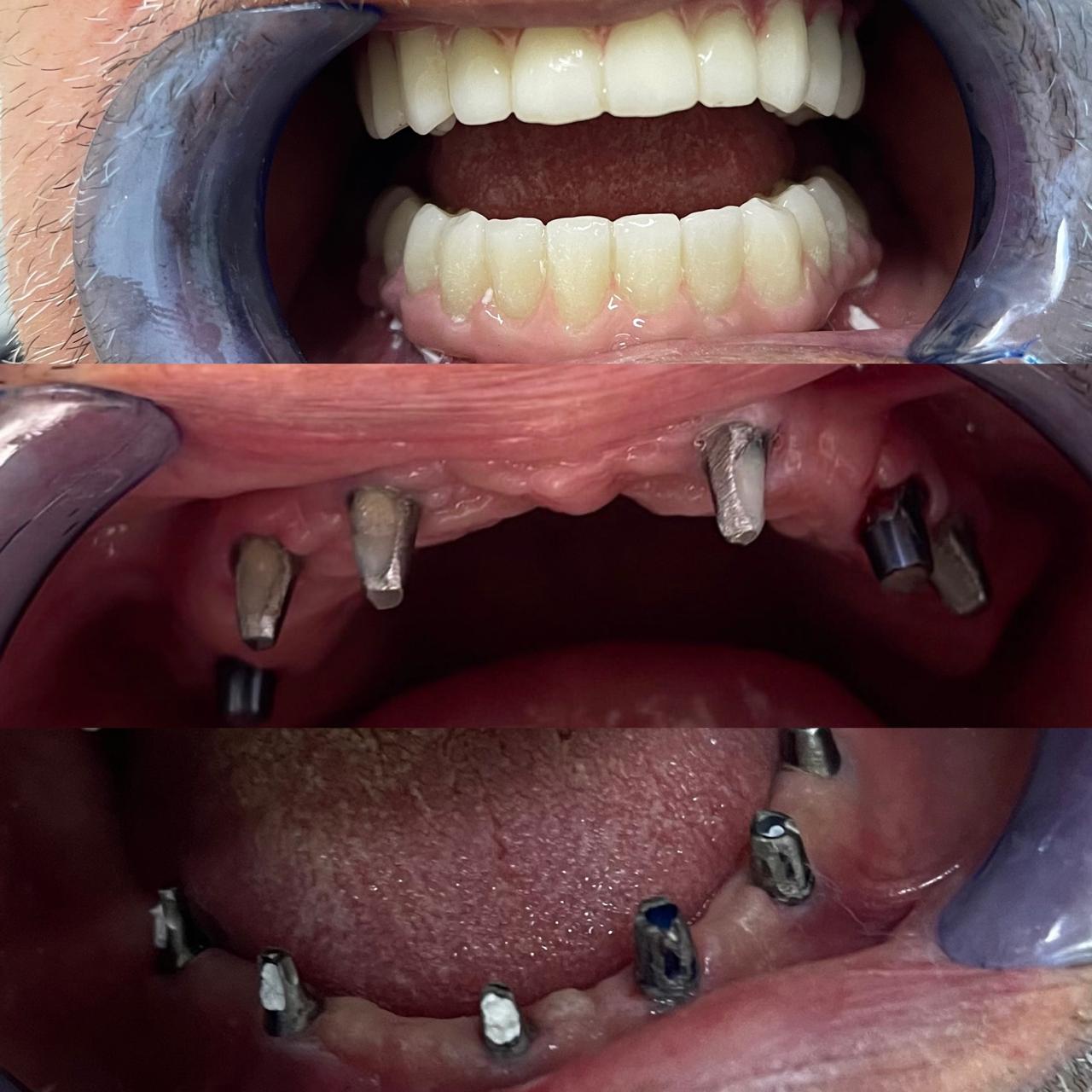 Rikonstruksion me implante dentare